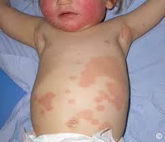psoriasis child