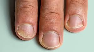 psoriasis nail